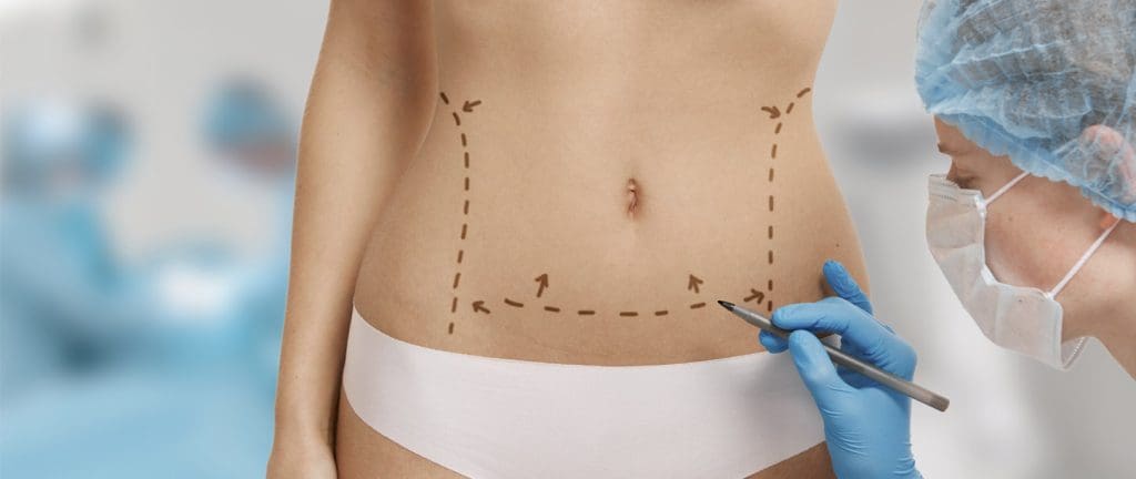 medicina cirugia estetica abdominoplastia
