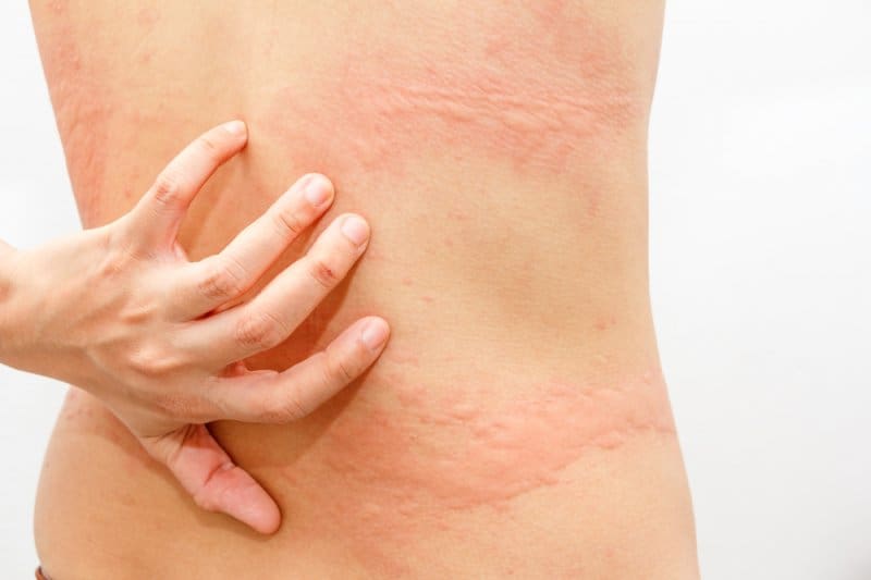 tipos de alergias