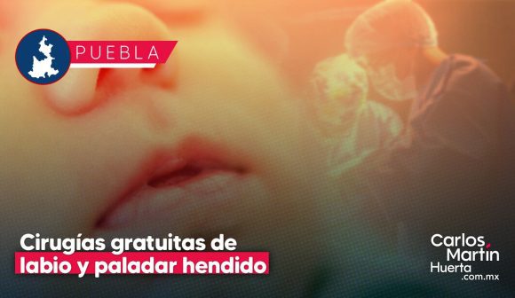 Nueva jornada de cirugías gratuitas para labio y paladar hendido en Puebla