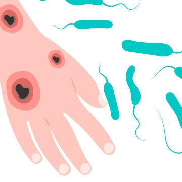 Alerta en Estados Unidos: Ocho muertes por bacteria “come carne” en el mar y mariscos crudos