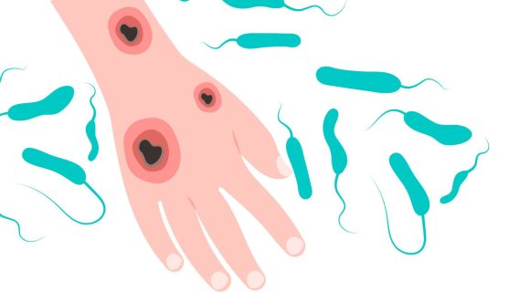 Alerta en Estados Unidos: Ocho muertes por bacteria “come carne” en el mar y mariscos crudos