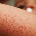 ¿Qué es el virus Coxsackie? Puebla reporta 11 casos en menores y aplica protocolos
