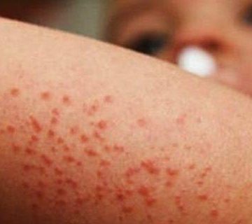 ¿Qué es el virus Coxsackie? Puebla reporta 11 casos en menores y aplica protocolos