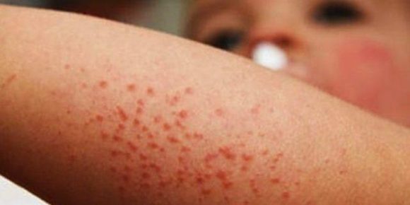 ¿Qué es el virus Coxsackie? Puebla reporta 11 casos en menores y aplica protocolos