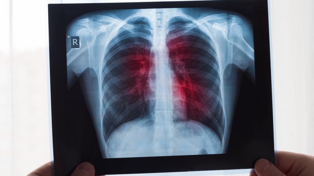 ¡Histórico! Realizan el primer trasplante de un pulmón de cerdo a un humano 3 ¡Historico Realizan el primer trasplante de un pulmon de cerdo a un humano 4