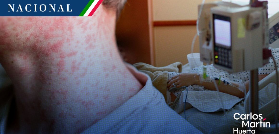 Alerta sanitaria: México suma 4 mil 353 casos de sarampión y 17 fallecimientos