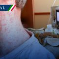 Alerta sanitaria: México suma 4 mil 353 casos de sarampión y 17 fallecimientos