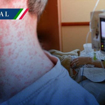 Alerta sanitaria: México suma 4 mil 353 casos de sarampión y 17 fallecimientos