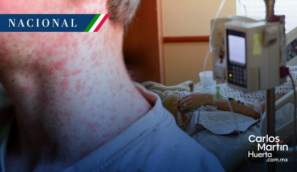 Alerta sanitaria: México suma 4 mil 353 casos de sarampión y 17 fallecimientos