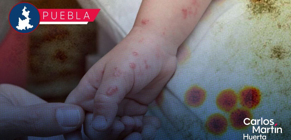Puebla reporta 201 casos de Coxsackie: Secretaría de Salud refuerza atención médica