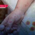 Puebla reporta 201 casos de Coxsackie: Secretaría de Salud refuerza atención médica