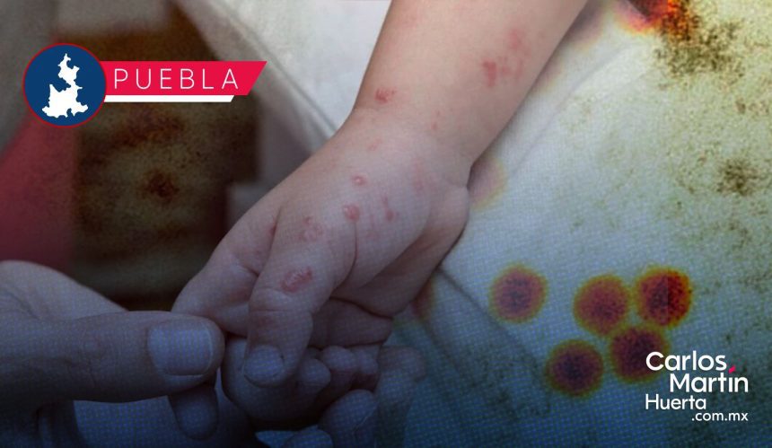 Brote de virus Coxsackie en Puebla: 386 casos y 58 brotes bajo vigilancia sanitaria