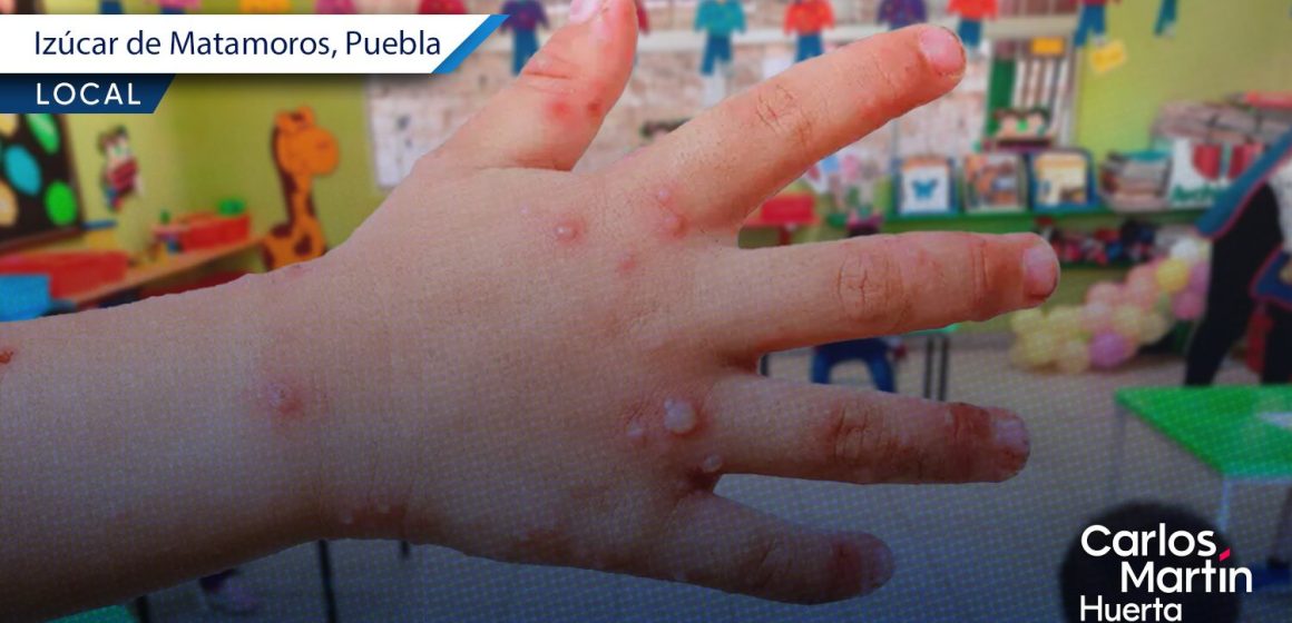 Suspenden clases en kínder de Izúcar de Matamoros por brote del virus Coxsackie
