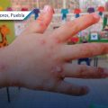 Suspenden clases en kínder de Izúcar de Matamoros por brote del virus Coxsackie