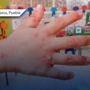 Suspenden clases en kínder de Izúcar de Matamoros por brote del virus Coxsackie