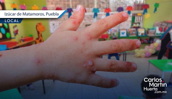 Suspenden clases en kínder de Izúcar de Matamoros por brote del virus Coxsackie