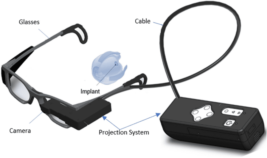 ¡Avance histórico! Prótesis ocular devuelve la capacidad de leer a pacientes con ceguera 1 ¡Avance histórico! Prótesis ocular devuelve la capacidad de leer a pacientes con ceguera