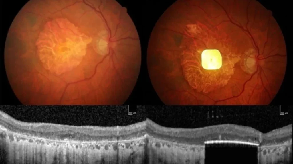 ¡Avance histórico! Prótesis ocular devuelve la capacidad de leer a pacientes con ceguera 2 ¡Avance historico Protesis ocular devuelve la capacidad de leer a pacientes con ceguera 4