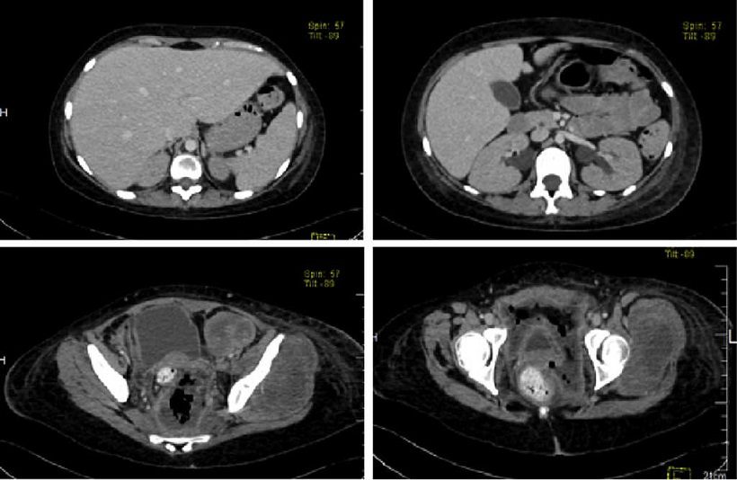 ¡Avance historico Identifican la celula que origina el Sarcoma de Erwing 2