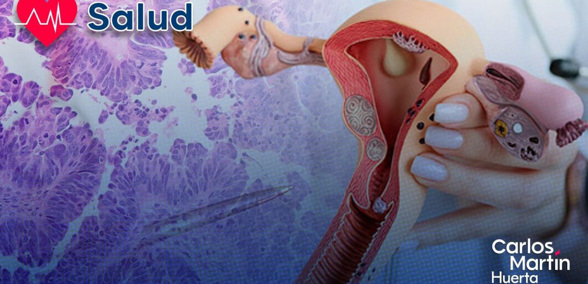 Cáncer de ovario Desarrollan terapia combinada para superar la resistencia a fármacos Cáncer de ovario: Desarrollan terapia combinada para superar la resistencia a fármacos