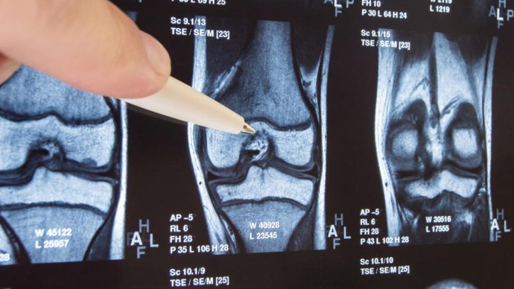 Descubren cómo regenerar el cartílago dañado por la artrosis 2 Descubren como regenerar el cartilago danado por la artrosis 3