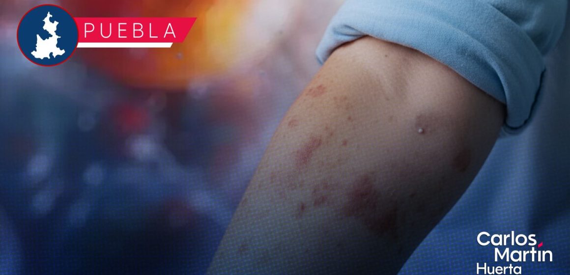Confirman primer caso de Sarampión en Puebla