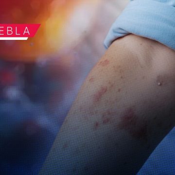 Confirman primer caso de Sarampión en Puebla