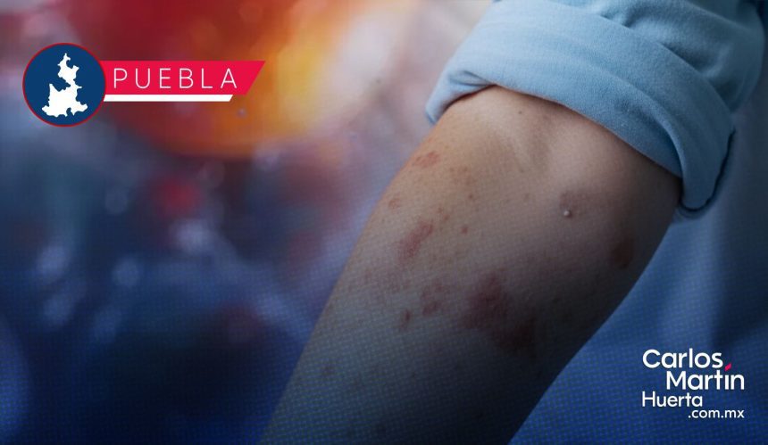 Confirman cuatro casos de Sarampión en Puebla; activan cercos sanitarios
