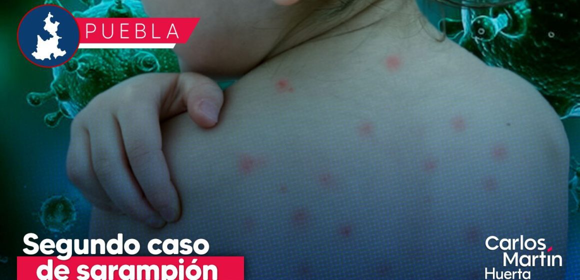 Confirman segundo caso de sarampión en Puebla