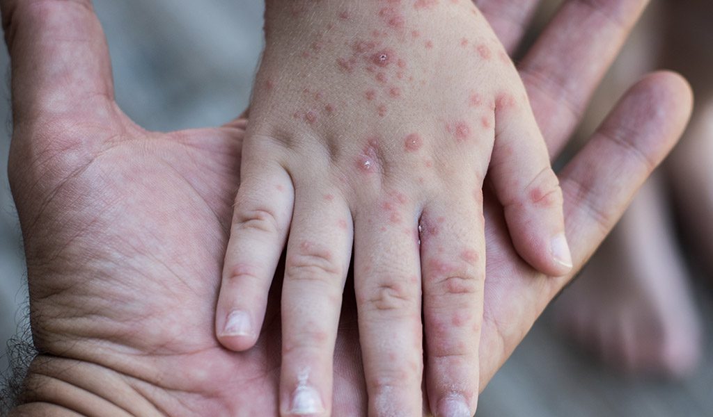 Confirman segundo caso de sarampión en Puebla