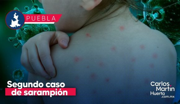 Confirman segundo caso de sarampión en Puebla