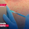 Conoce dónde puedes vacunarte contra el Sarampión en Puebla