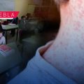Detectan caso de sarampión en el Centro Escolar Comunitario Sur