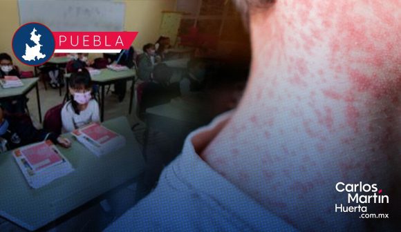 Detectan caso de sarampión en el Centro Escolar Comunitario Sur
