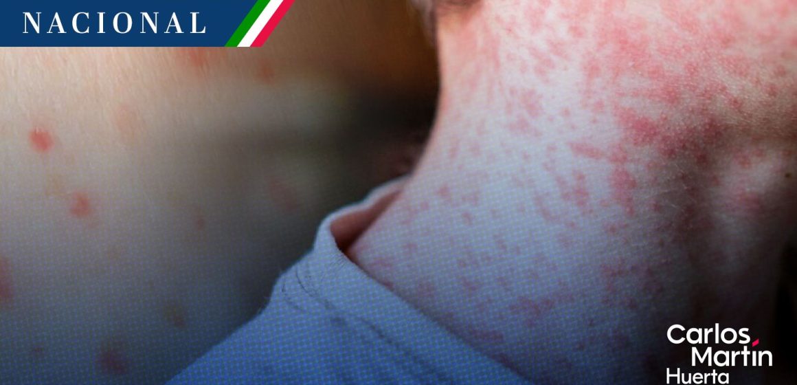 Sarampión en México: Salud anuncia ampliación de estrategia, dispone de 23 millones de vacunas