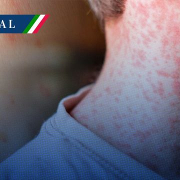 Sarampión Secretaría de Salud busca salvar estatus de país libre de sarampión en dos meses