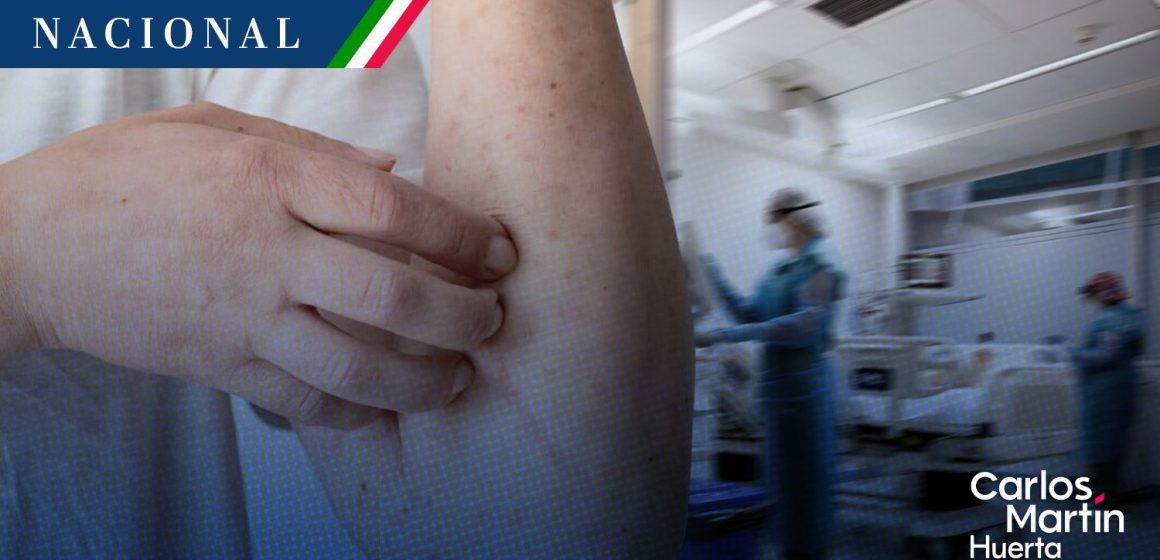 Secretaría de Salud confirma la primera muerte por sarampión en México este 2026