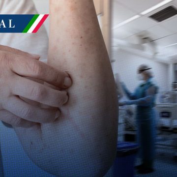 Secretaría de Salud confirma la primera muerte por sarampión en México este 2026