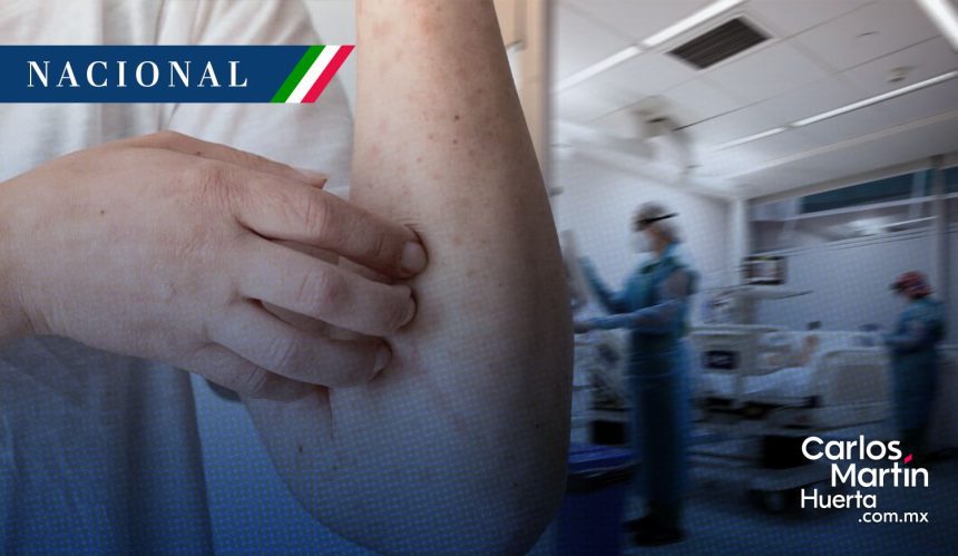 Secretaría de Salud confirma la primera muerte por sarampión en México este 2026