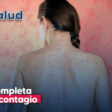 Sarampión en México: Guía sobre contagio, esquema de vacunación y prevención
