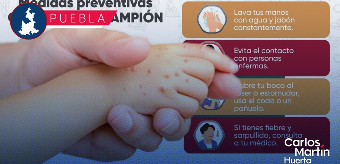 Secretaría de Salud refuerza vigilancia epidemiológica por segundo caso de sarampión en Puebla