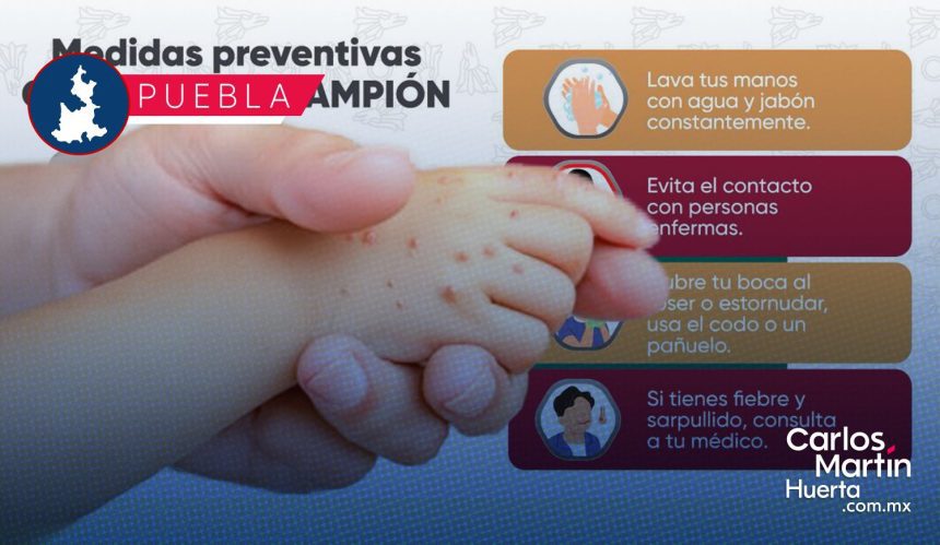 Exhortan a reforzar medidas sanitarias en escuelas ante aumento de casos de sarampión en Puebla