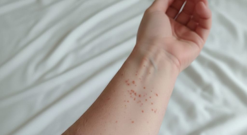 Secretaría de Salud confirma primer caso de sarampión en Puebla