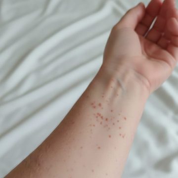 Secretaría de Salud confirma primer caso de sarampión en Puebla