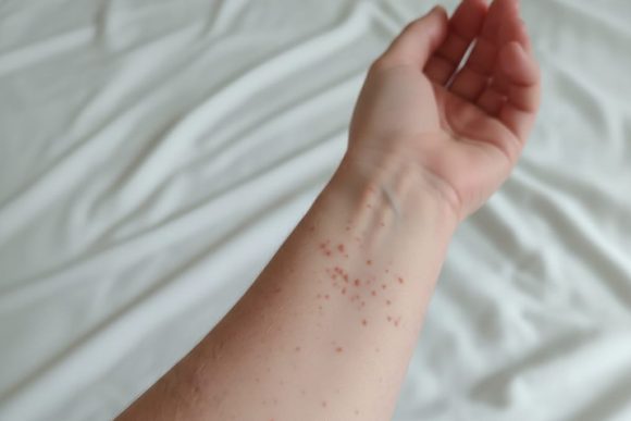 Secretaría de Salud confirma primer caso de sarampión en Puebla