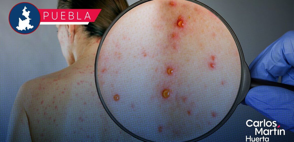 Ya son siete casos de Sarampión en Puebla