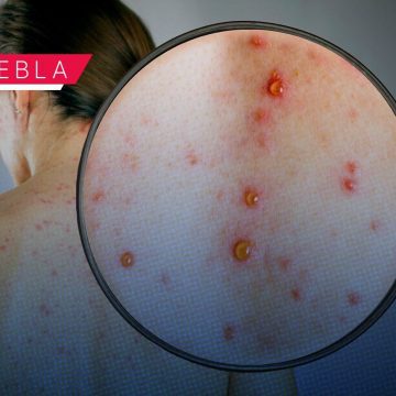 Portada Ya son 7 casos de Sarampión en Puebla CMH Ya son siete casos de Sarampión en Puebla