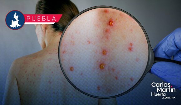 Detectan sarampión en plantel educativo de Puebla; implementan filtros sanitarios