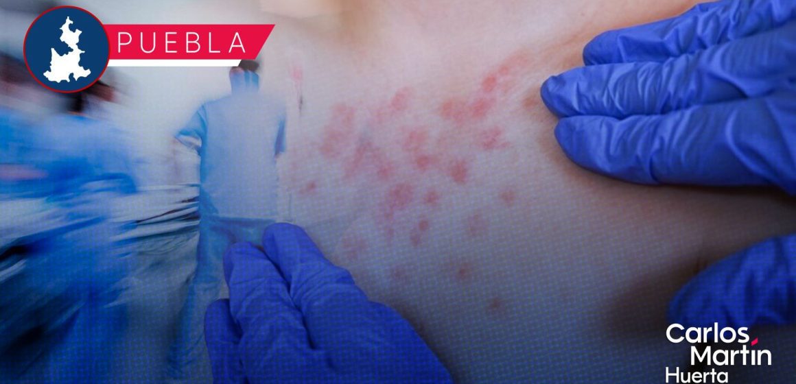 Alerta por Sarampión en Puebla: Suman 44 casos confirmados y 159 en observación