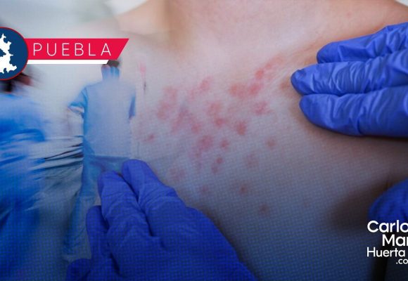 Ya son 95 casos de Sarampión en Puebla; hay 307 probables